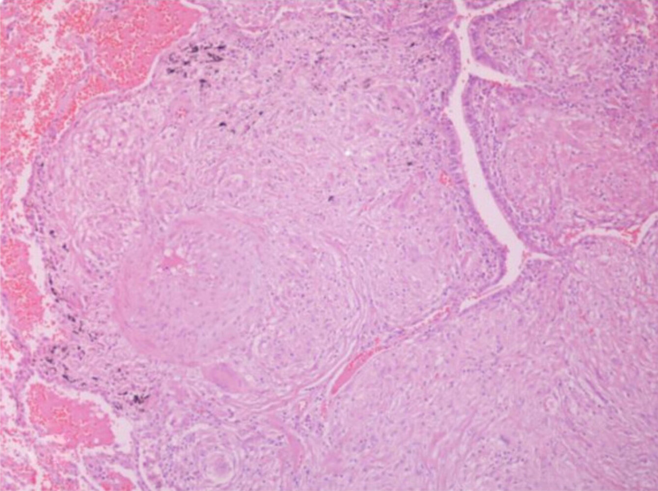 Noncaseating granuloma