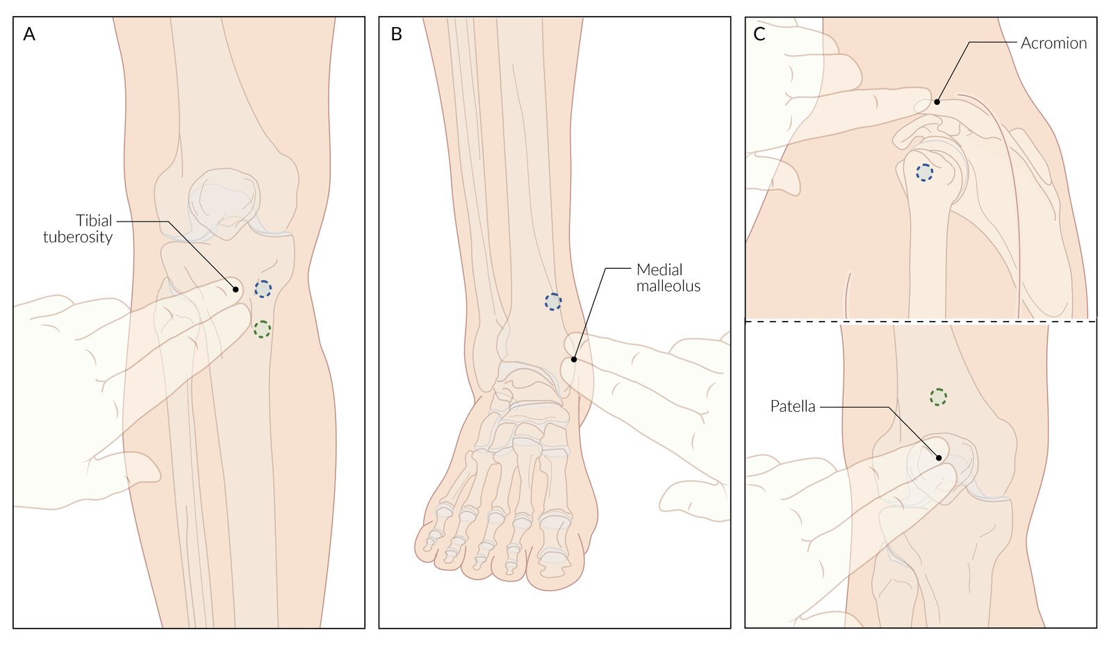 Intraosseous access insertion site