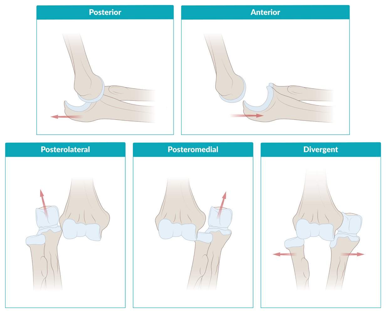 Classification of elbow dislocation by anatomical position