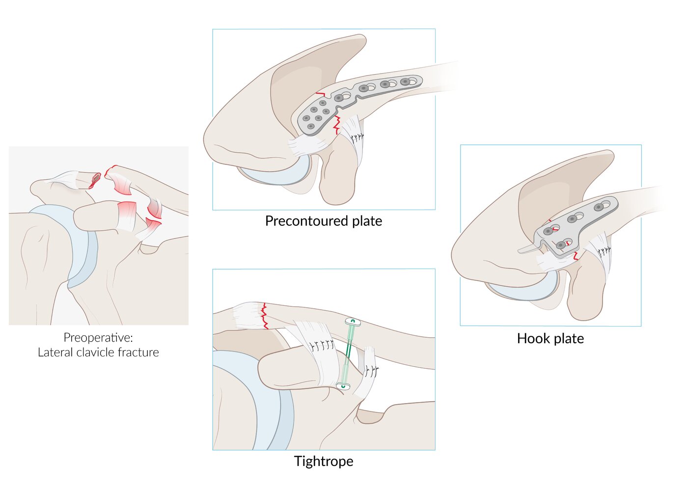 Surgical treatment options for lateral clavicle fracture
