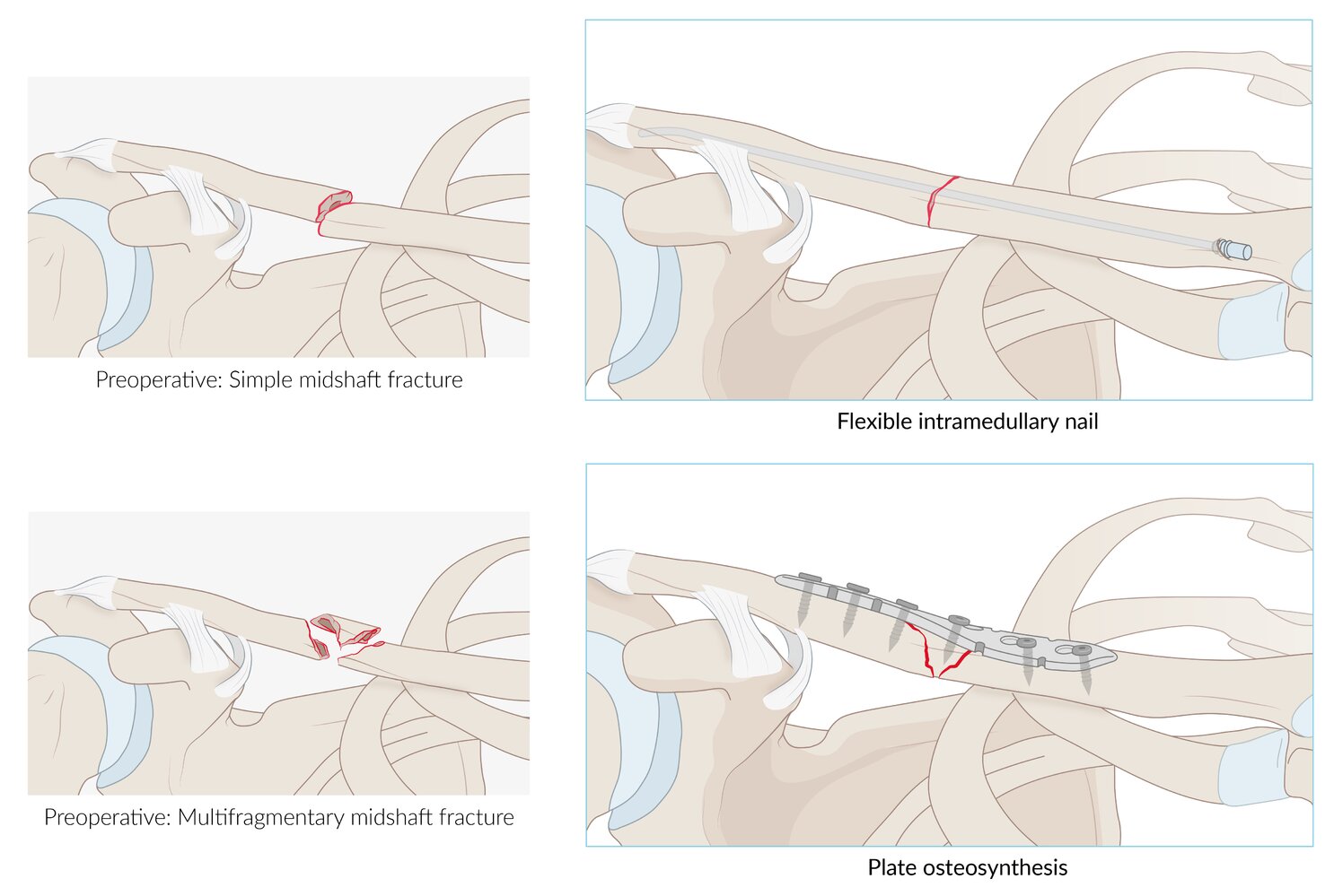 Surgical treatment options for midshaft clavicle fractures