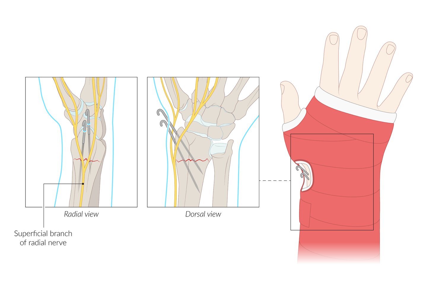 Surgical therapy of distal radius fracture: K-wire fixation