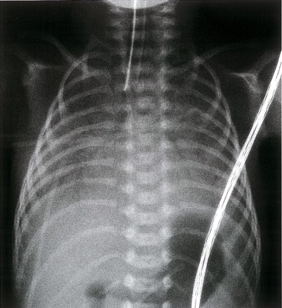 Neonatal respiratory distress syndrome