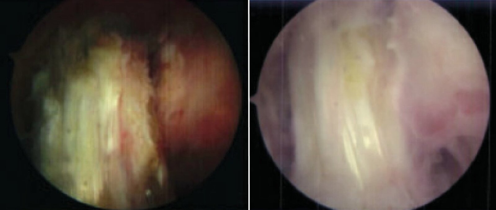 Acute septic arthritis