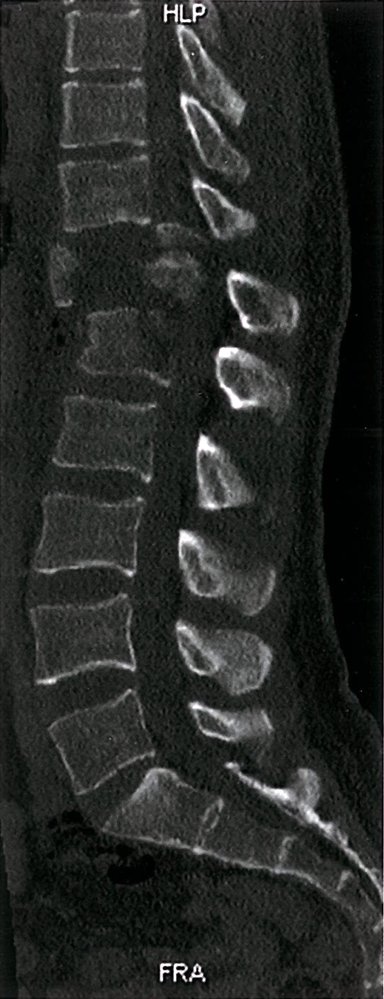 T12 burst fracture and L1 fracture