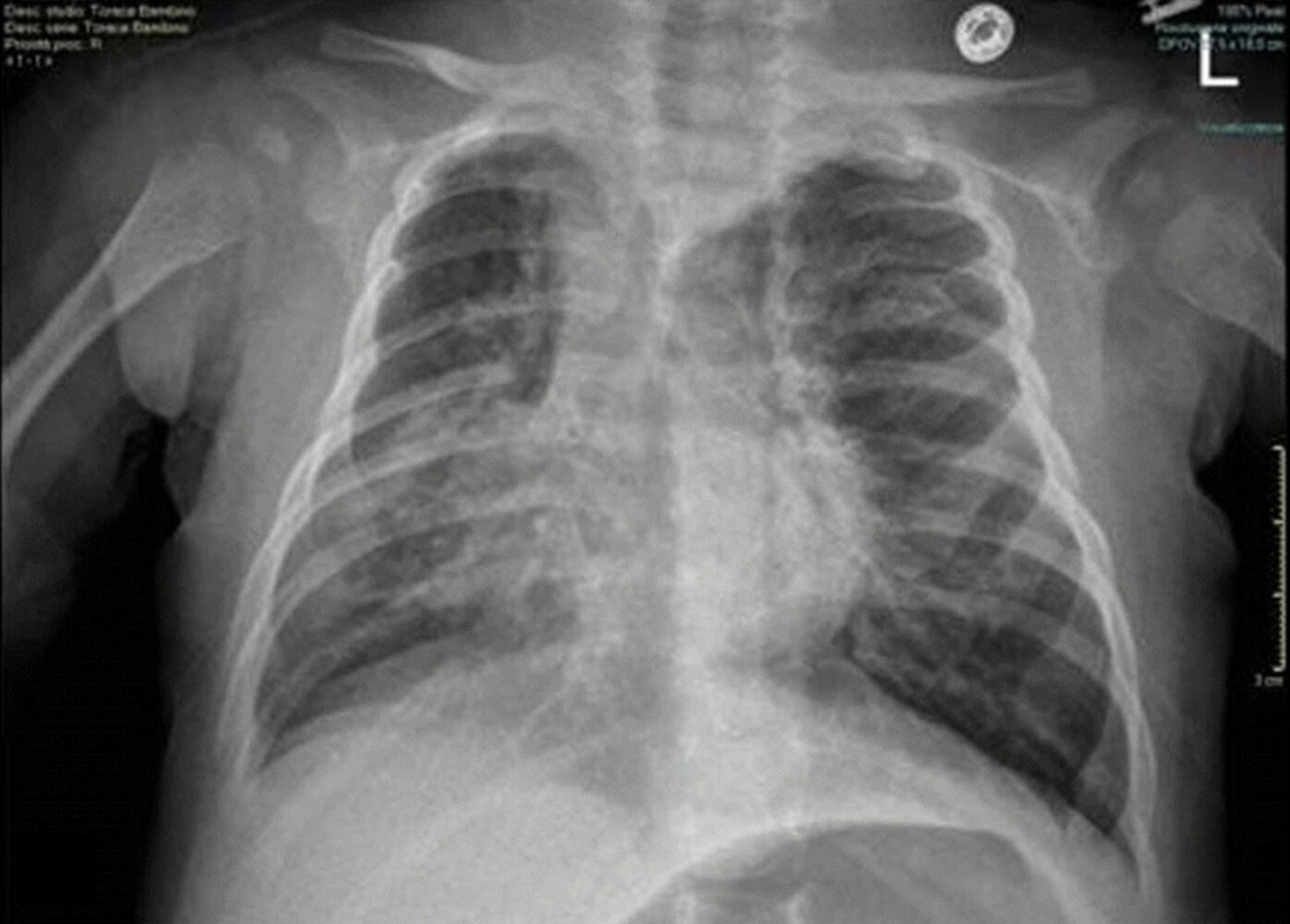 Bilateral hyperinflation and right lung consolidation