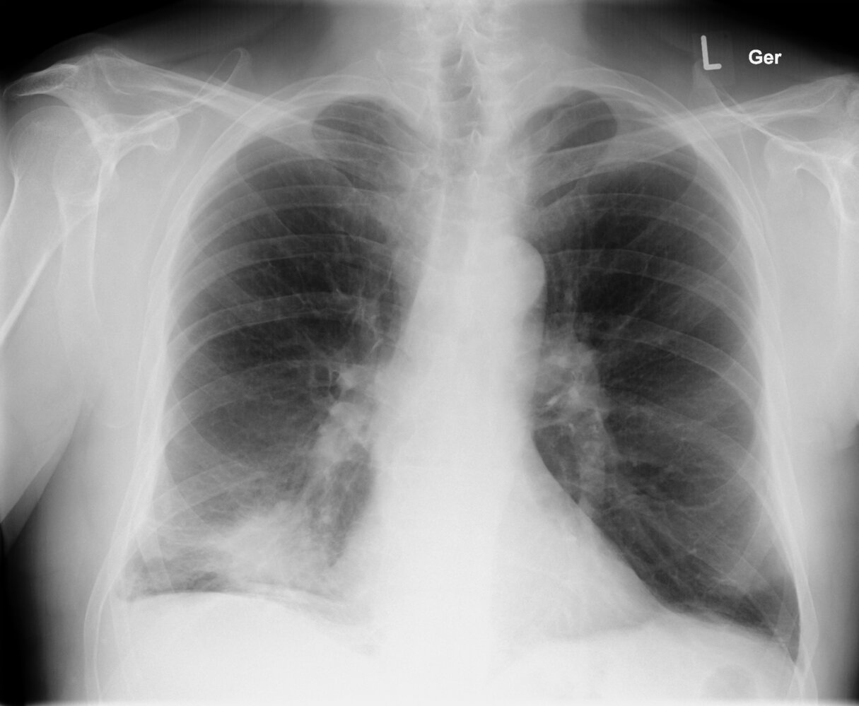 Spiculated lung mass