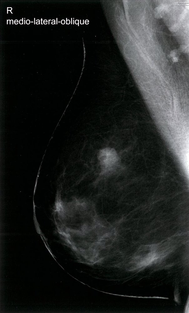 Mammography in breast cancer