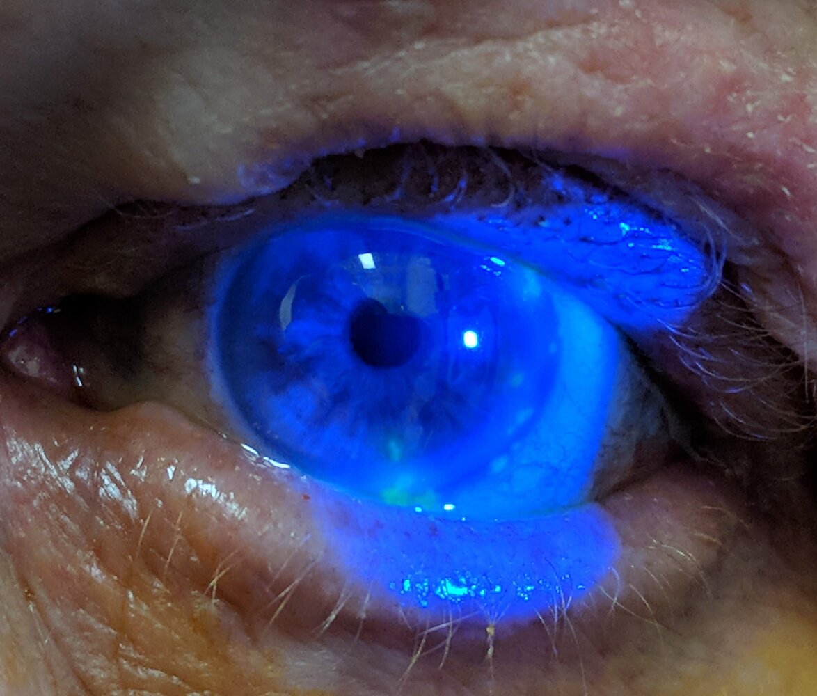 Herpes zoster keratitis