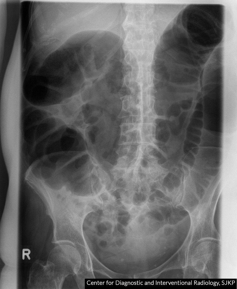 Distal large bowel obstruction (1/2)