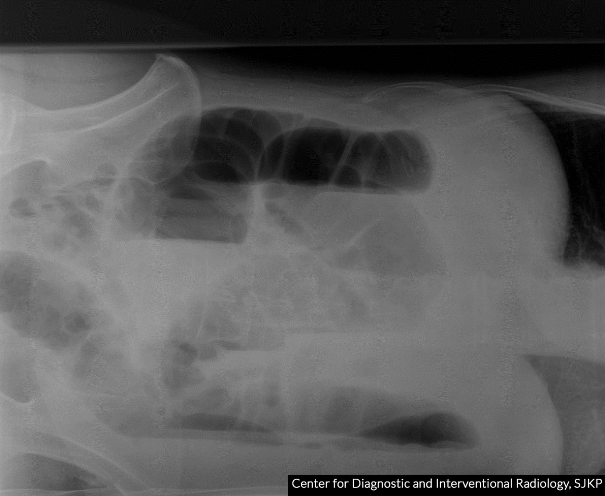 Distal large bowel obstruction (2/2)