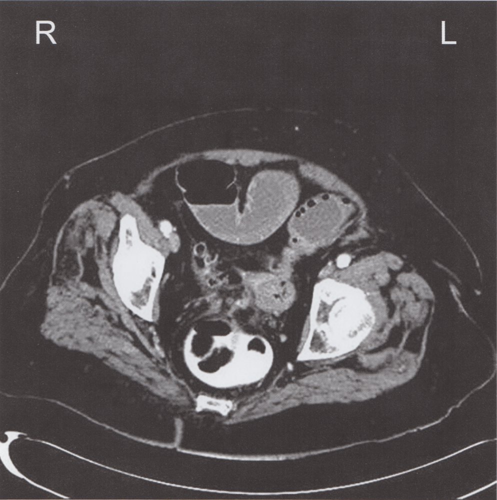 Intestinal obstruction from chronic diverticulitis (3/3)