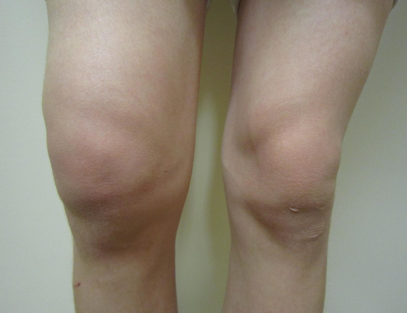 Knee effusion