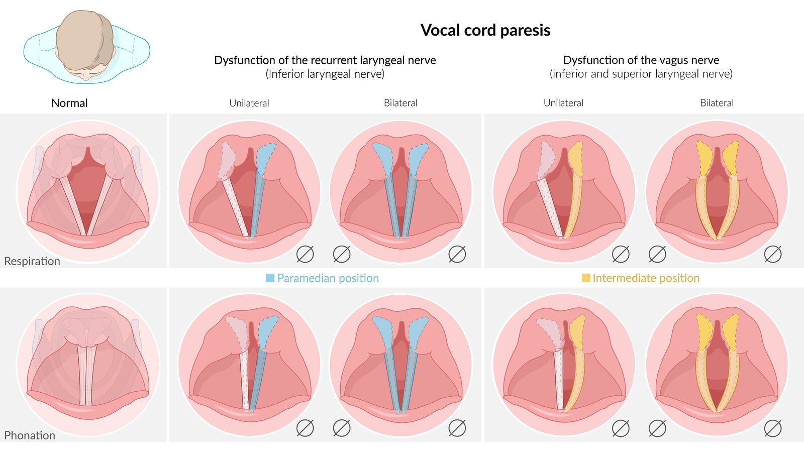 Vocal cord paralysis
