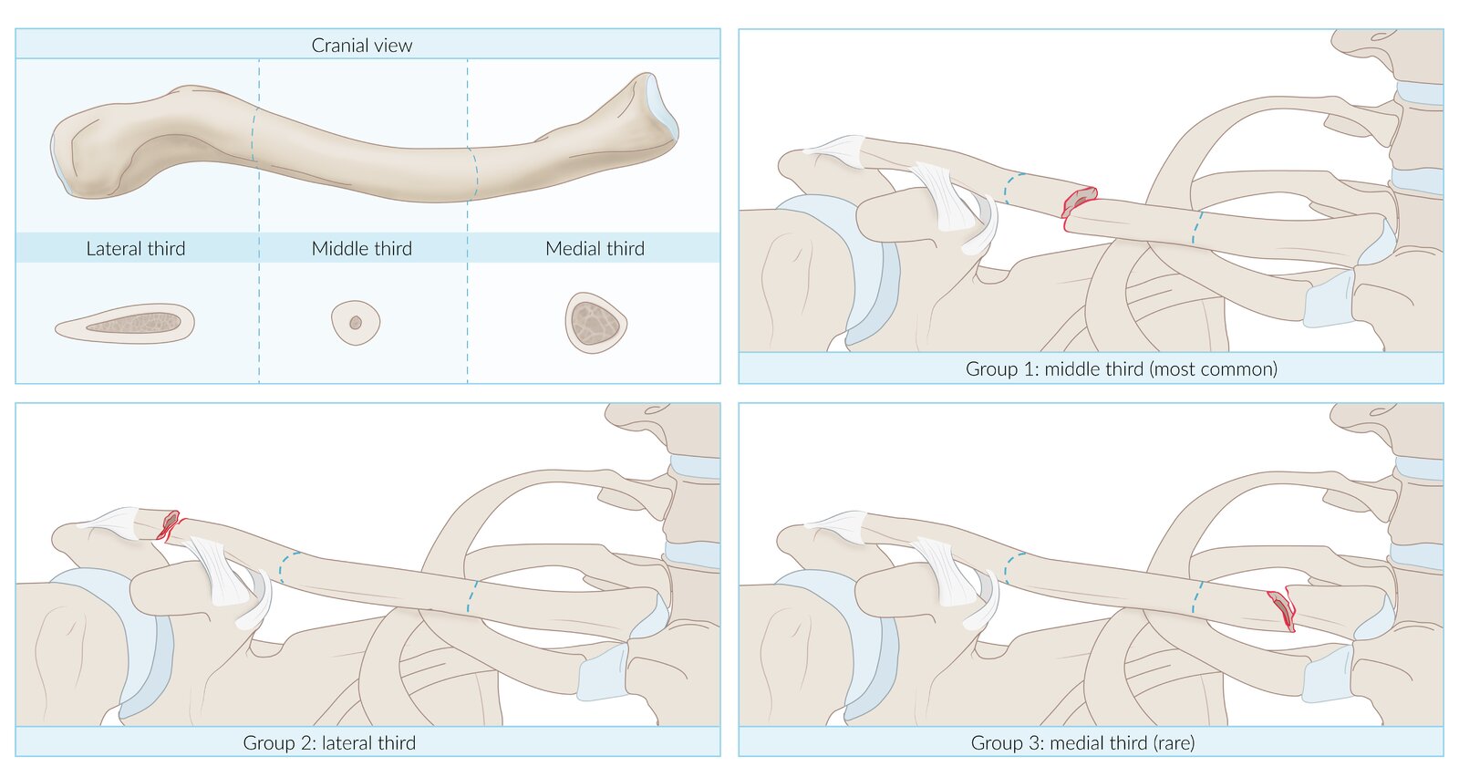 Allman classification of clavicle fractures