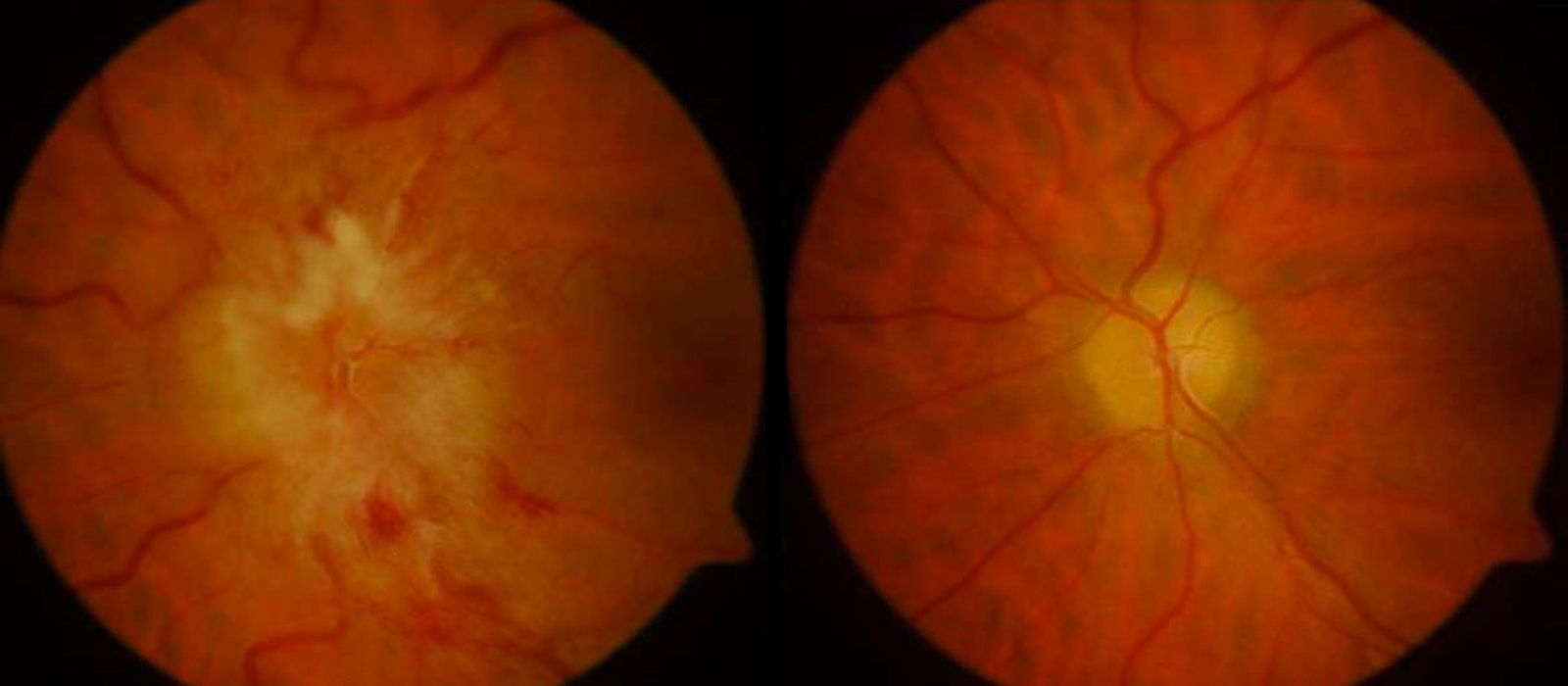 Optic disc edema
