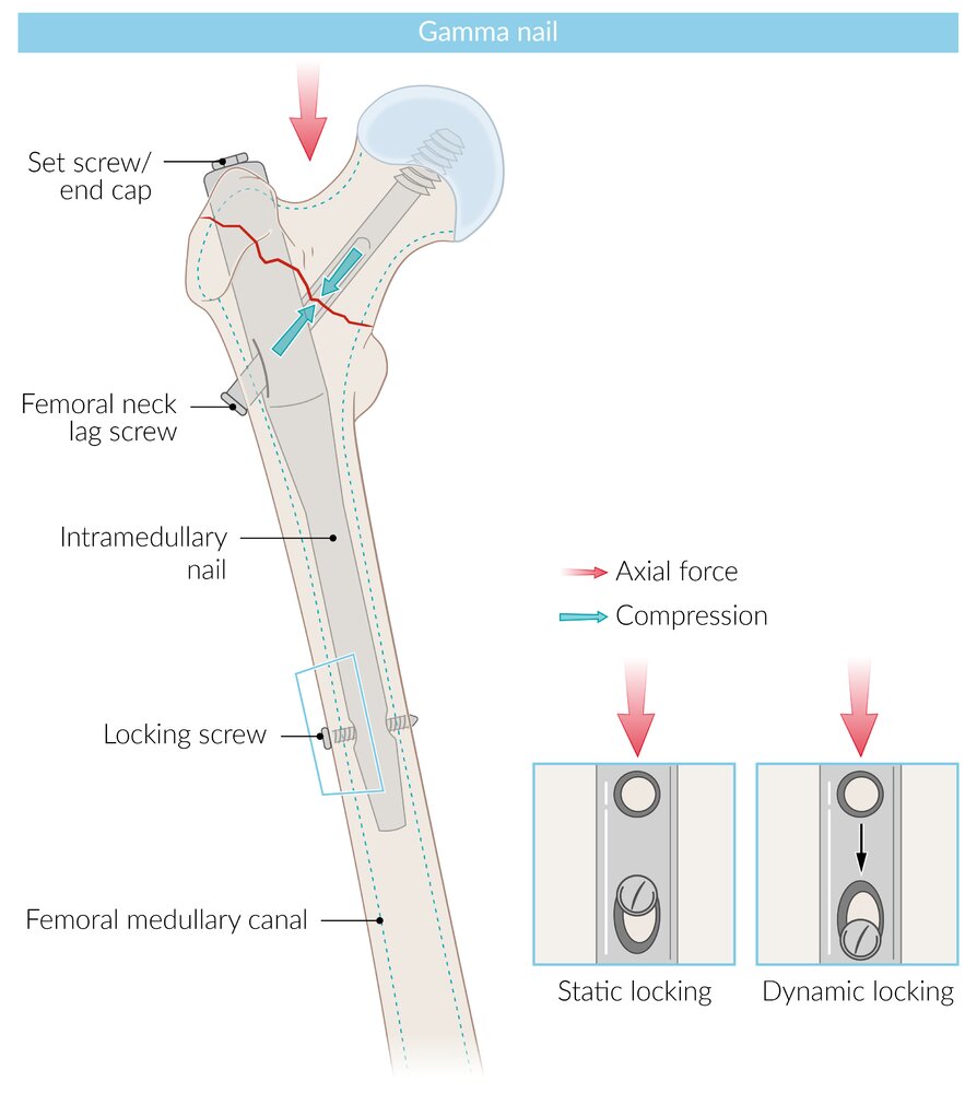 Intramedullary nail (gamma locking nail)