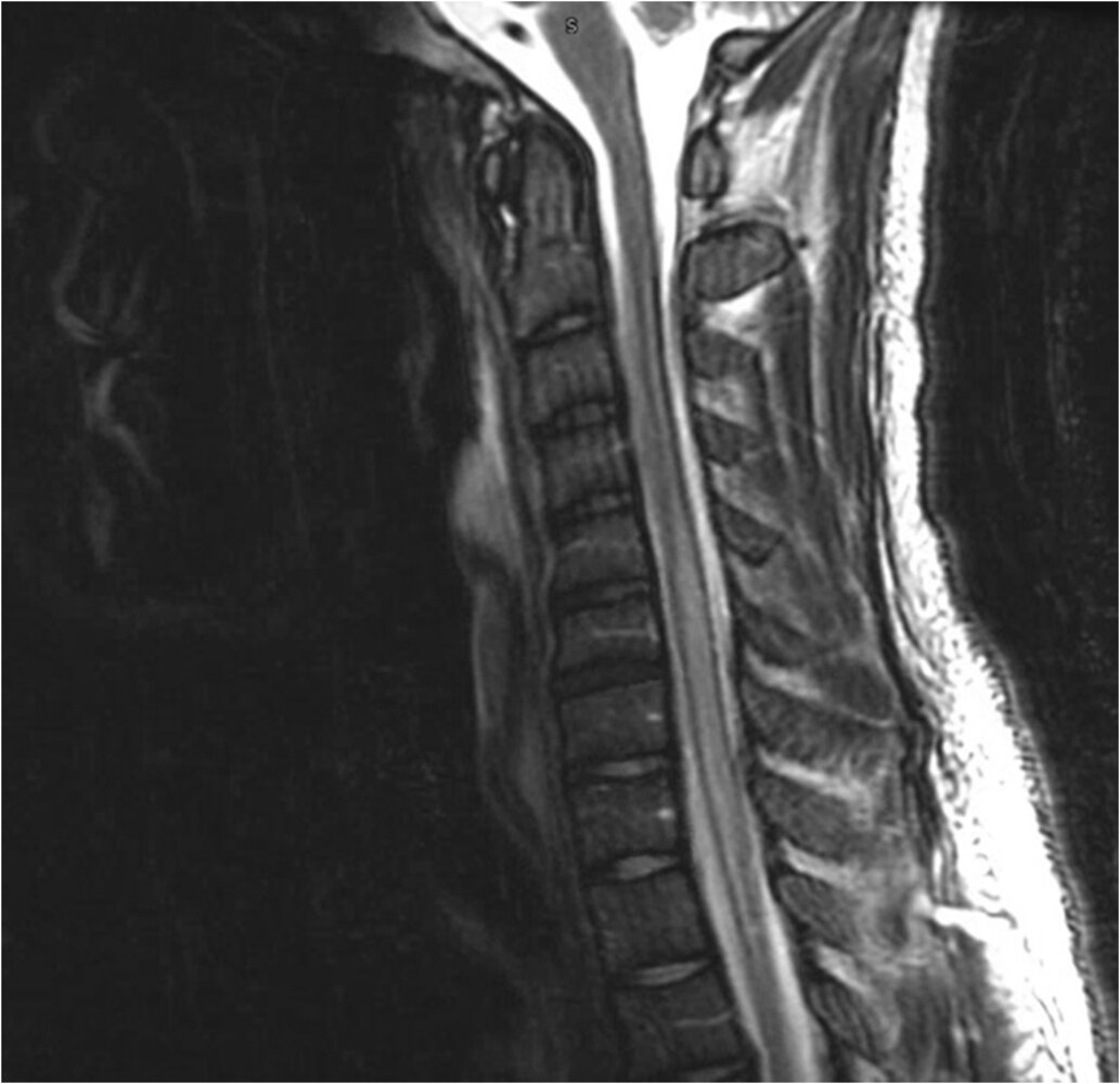 Transverse myelitis