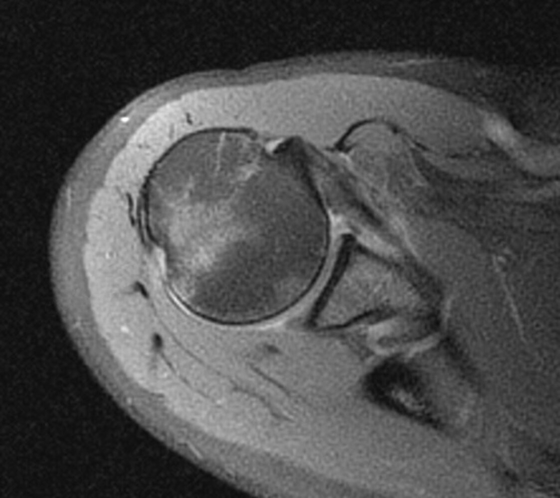 Hill-Sachs lesion