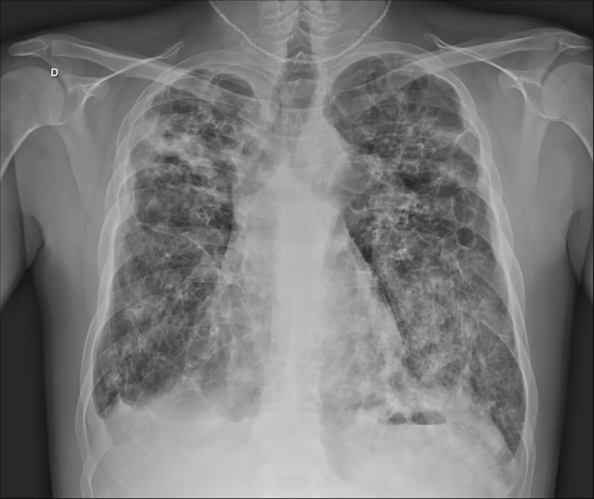 Cystic fibrosis with concurrent pneumonia