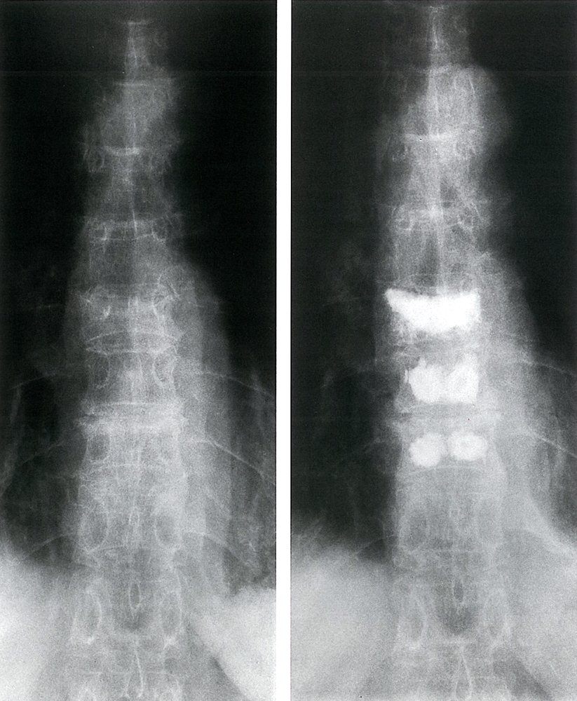 Vertebral body compression fractures before and after kyphoplasty