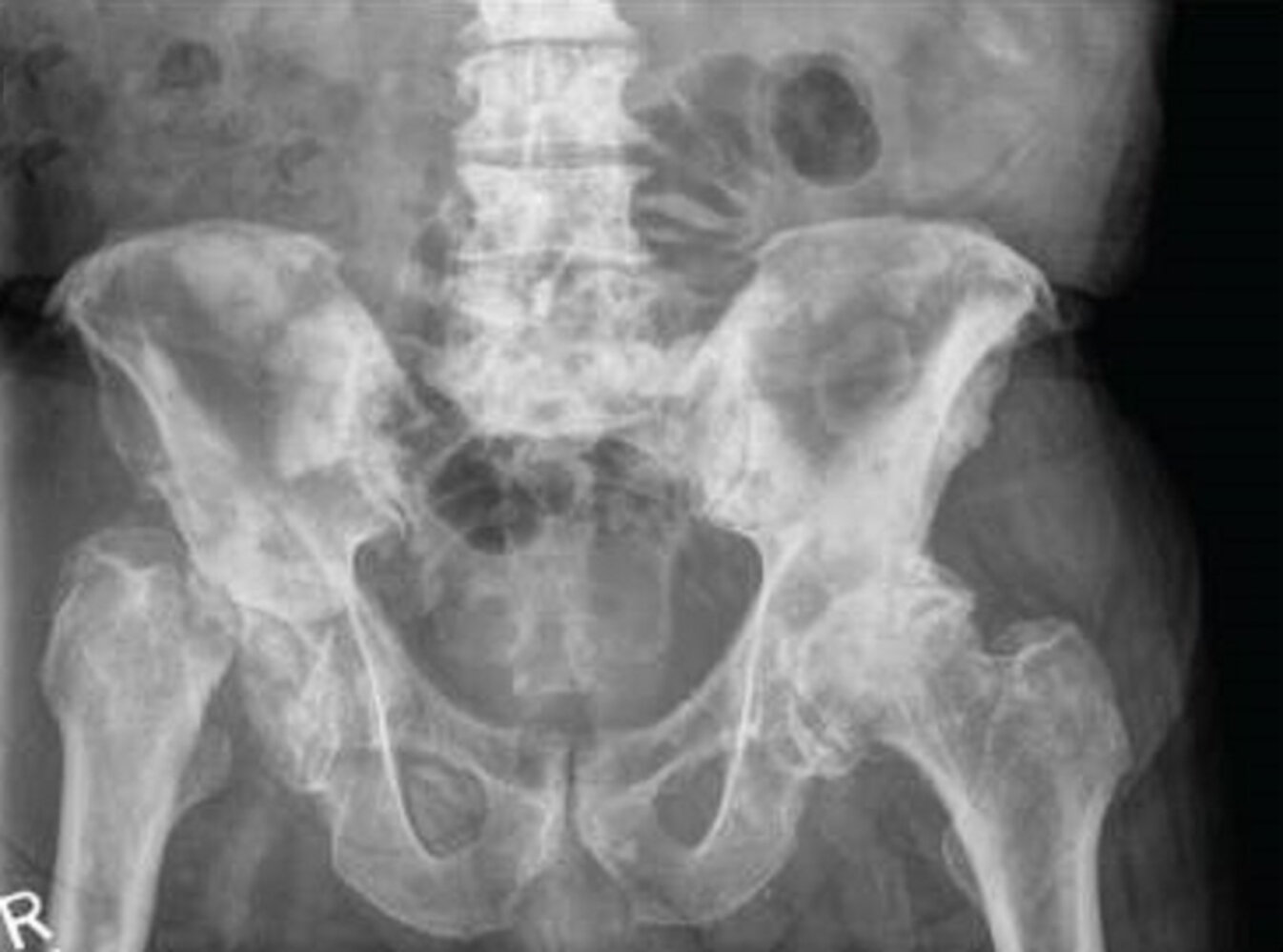 Sclerotic bone metastases