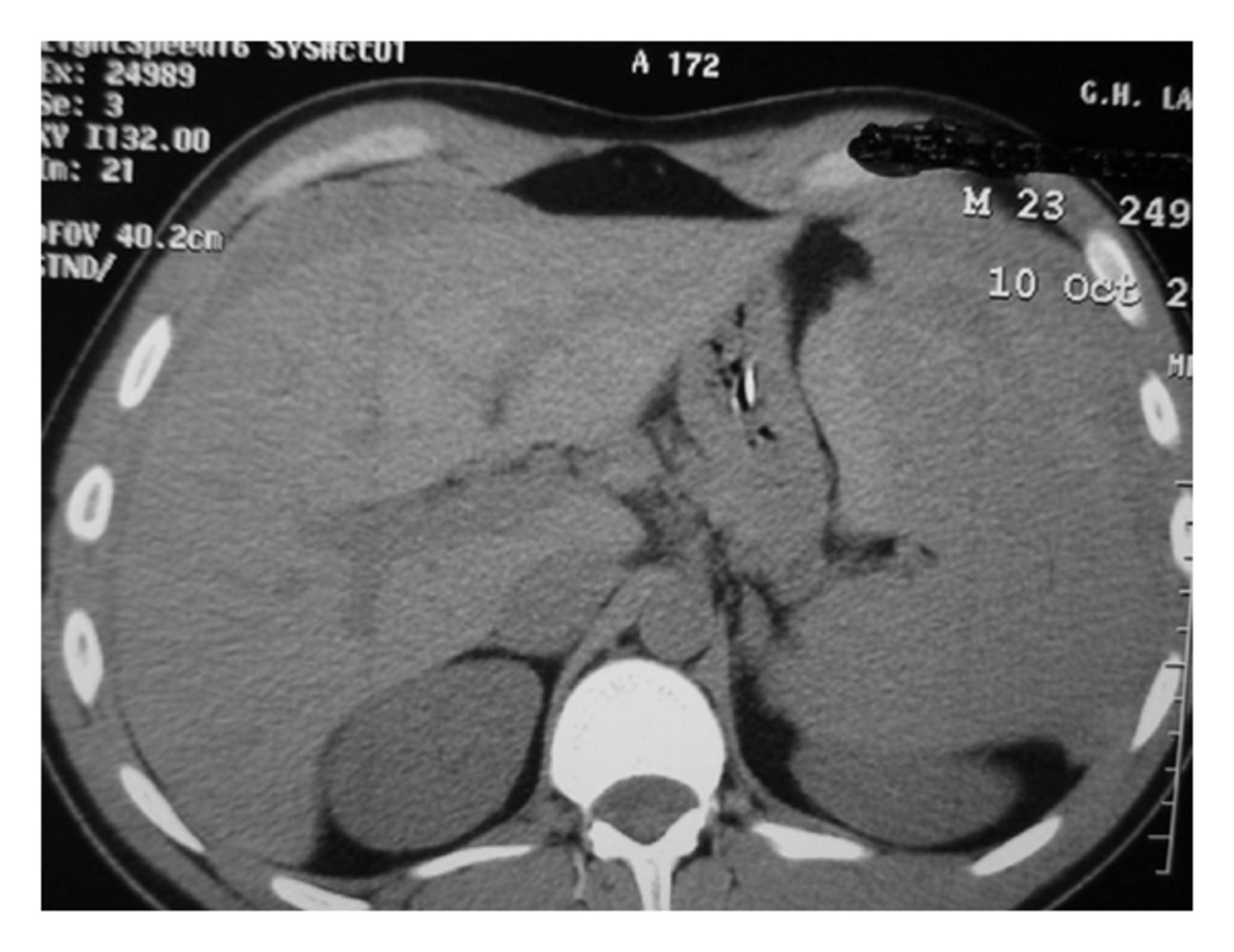 Hemoperitoneum