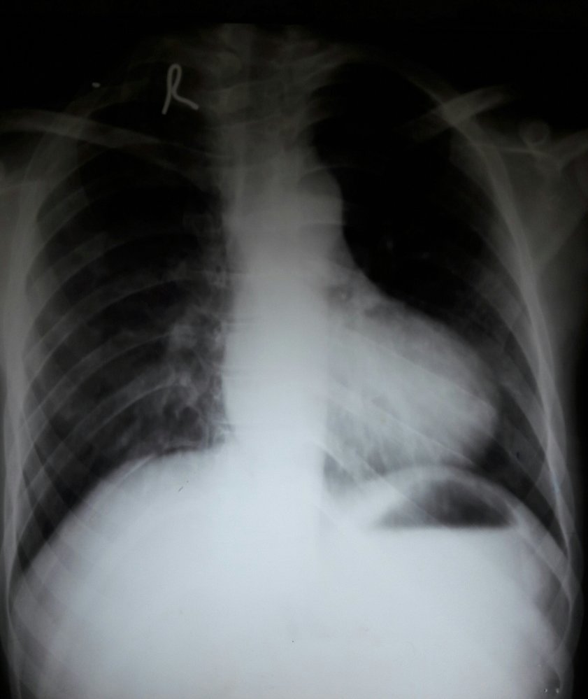 Boot-shaped heart in tetralogy of Fallot