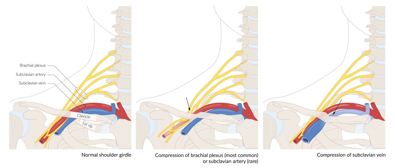 Thoracic outlet syndrome secondary to clavicle fracture