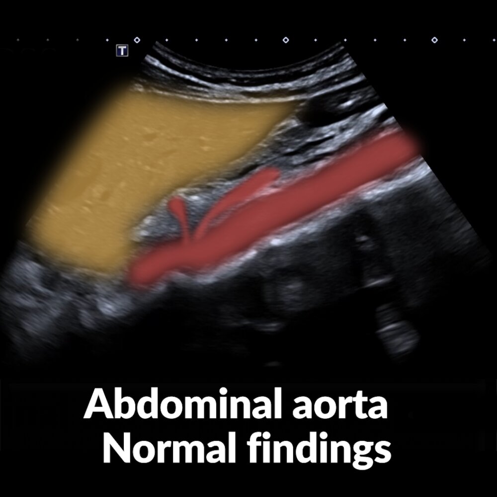 POCUS (abdomen): abdominal aorta normal findings