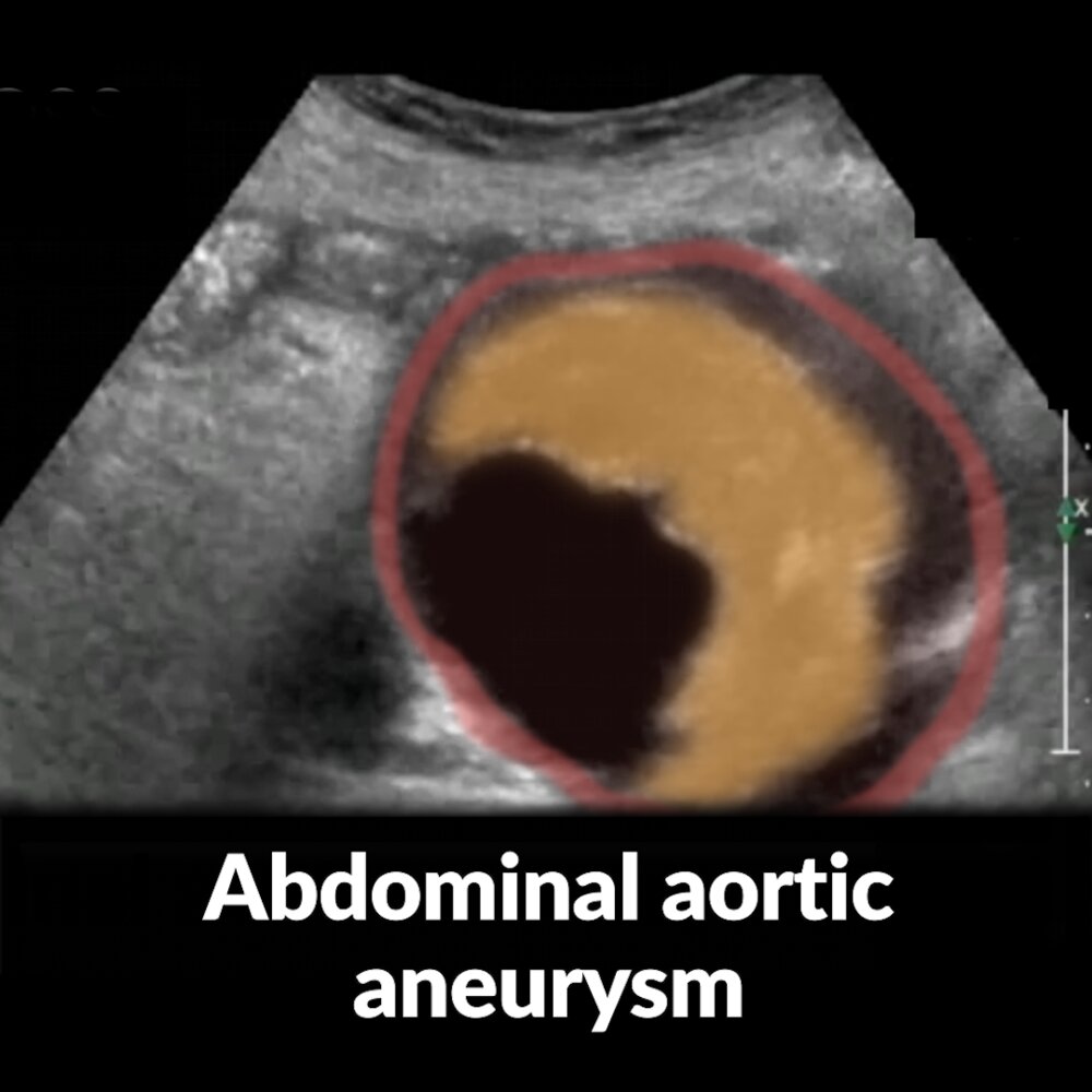 POCUS (abdomen): aortic aneurysm