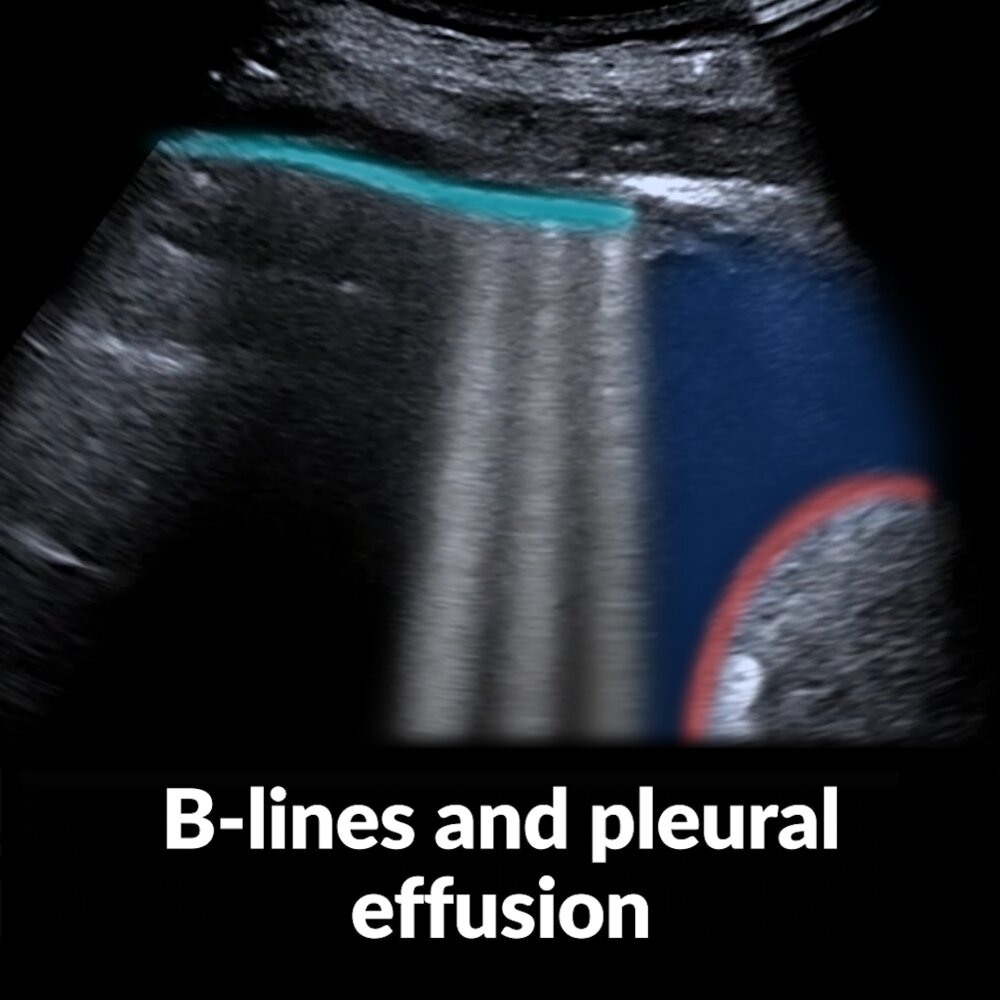 POCUS (lung): B-lines and pleural effusion