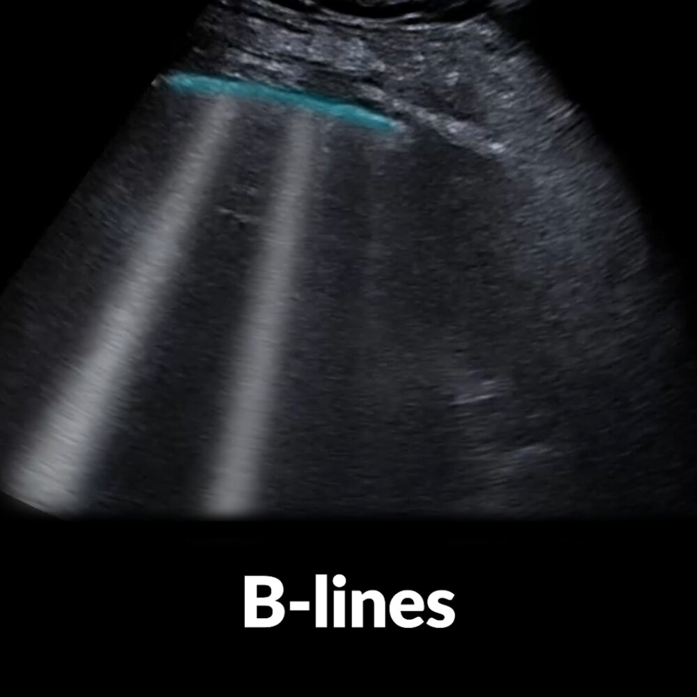 POCUS (lung): B-lines