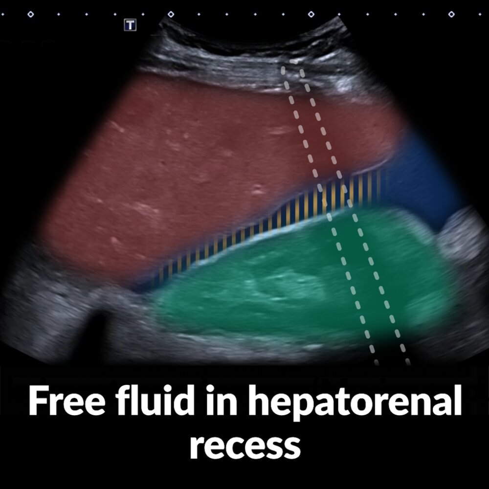POCUS (abdomen): free fluid in hepatorenal recess (Morison pouch)