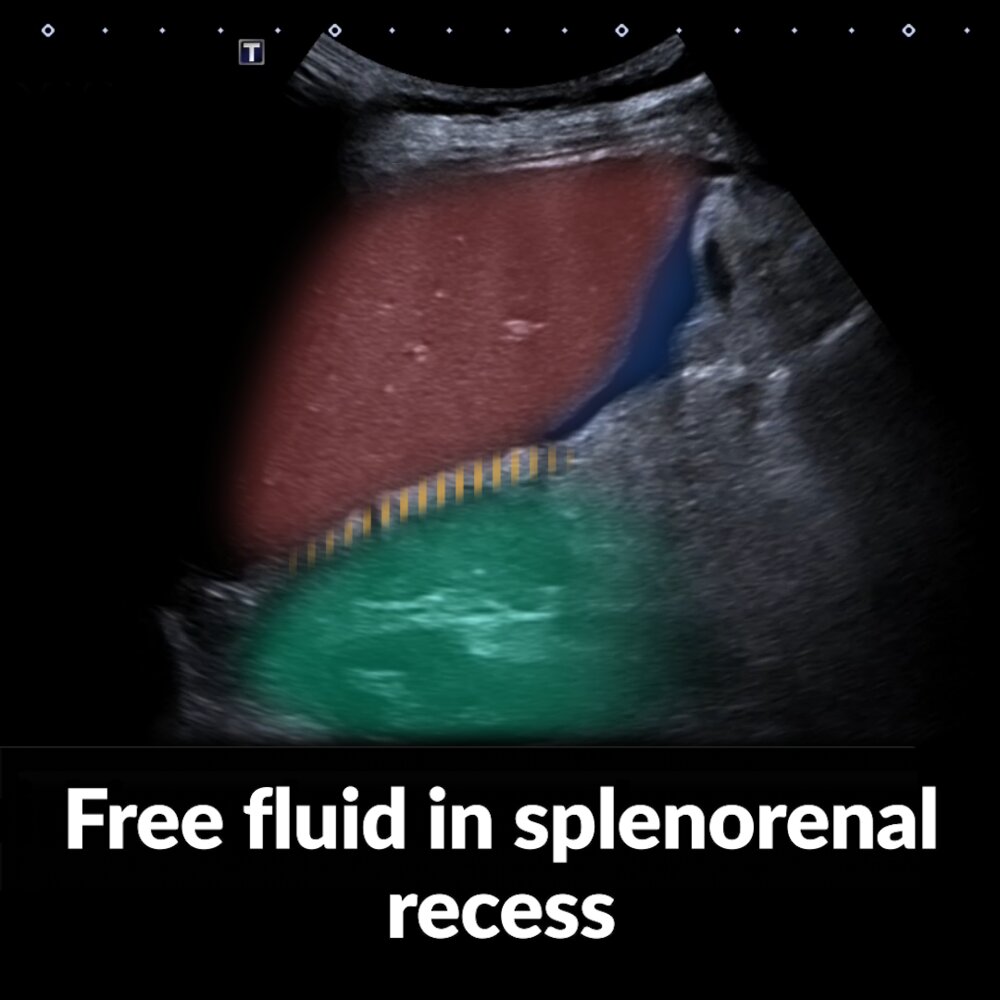 POCUS (abdomen): free fluid in splenorenal recess