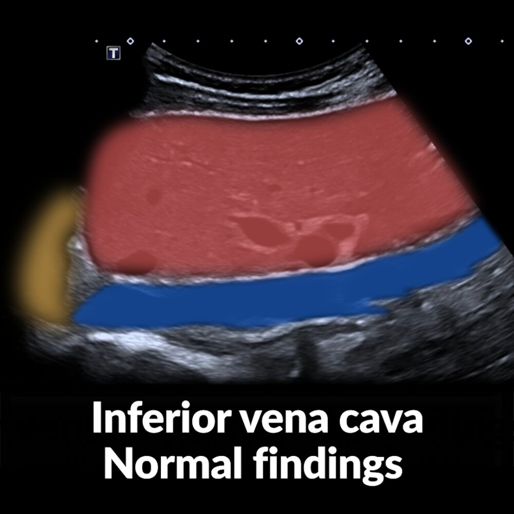 POCUS (abdomen): inferior vena cava normal findings