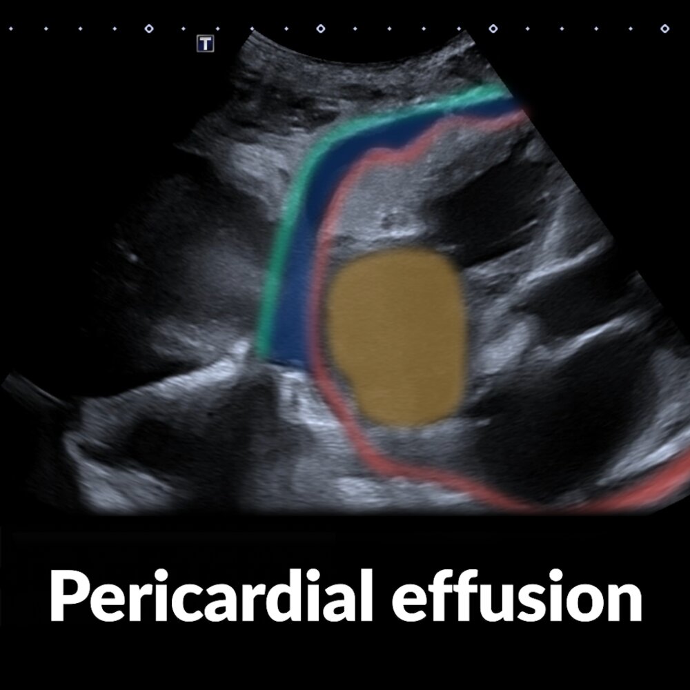 POCUS (heart): pericardial effusion