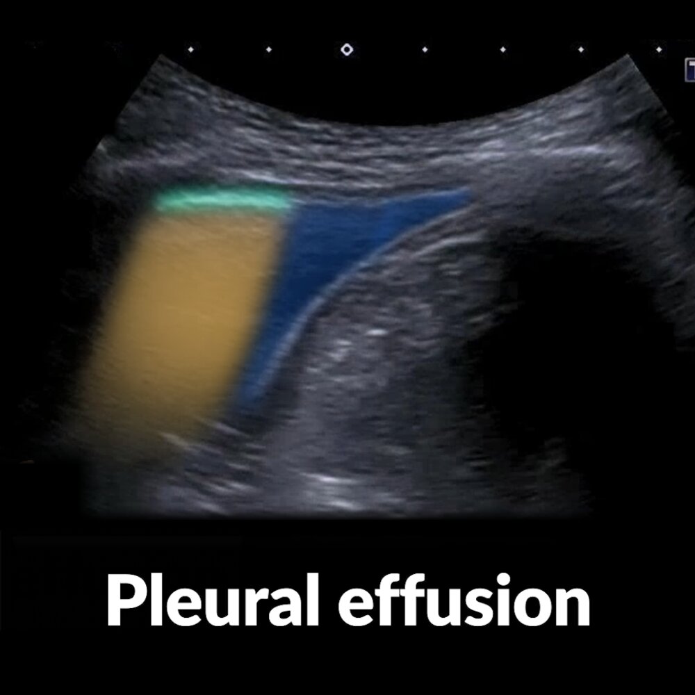 POCUS (lung): pleural effusion