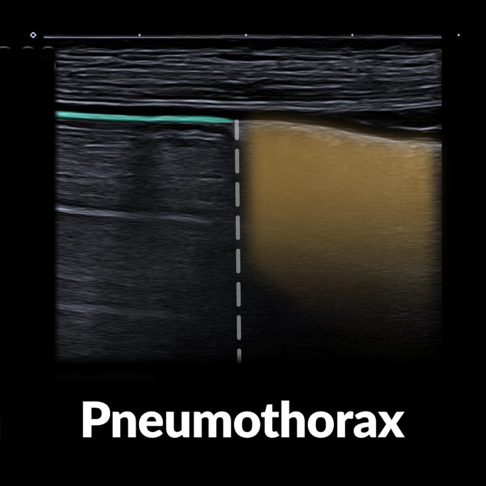 POCUS (lung): pneumothorax