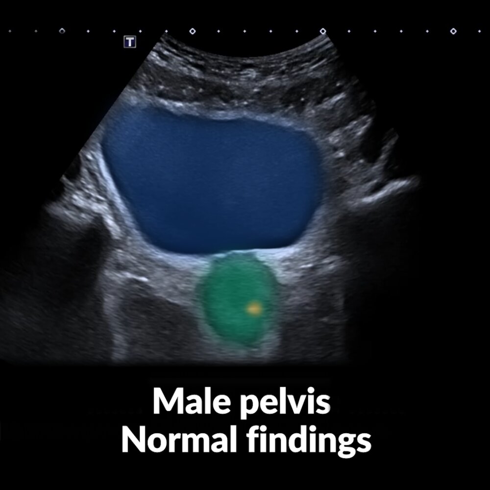 POCUS (male pelvis): normal findings