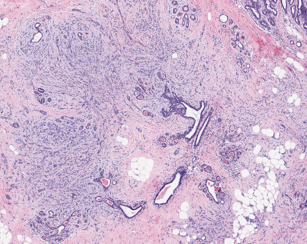 Invasive lobular carcinoma of the breast