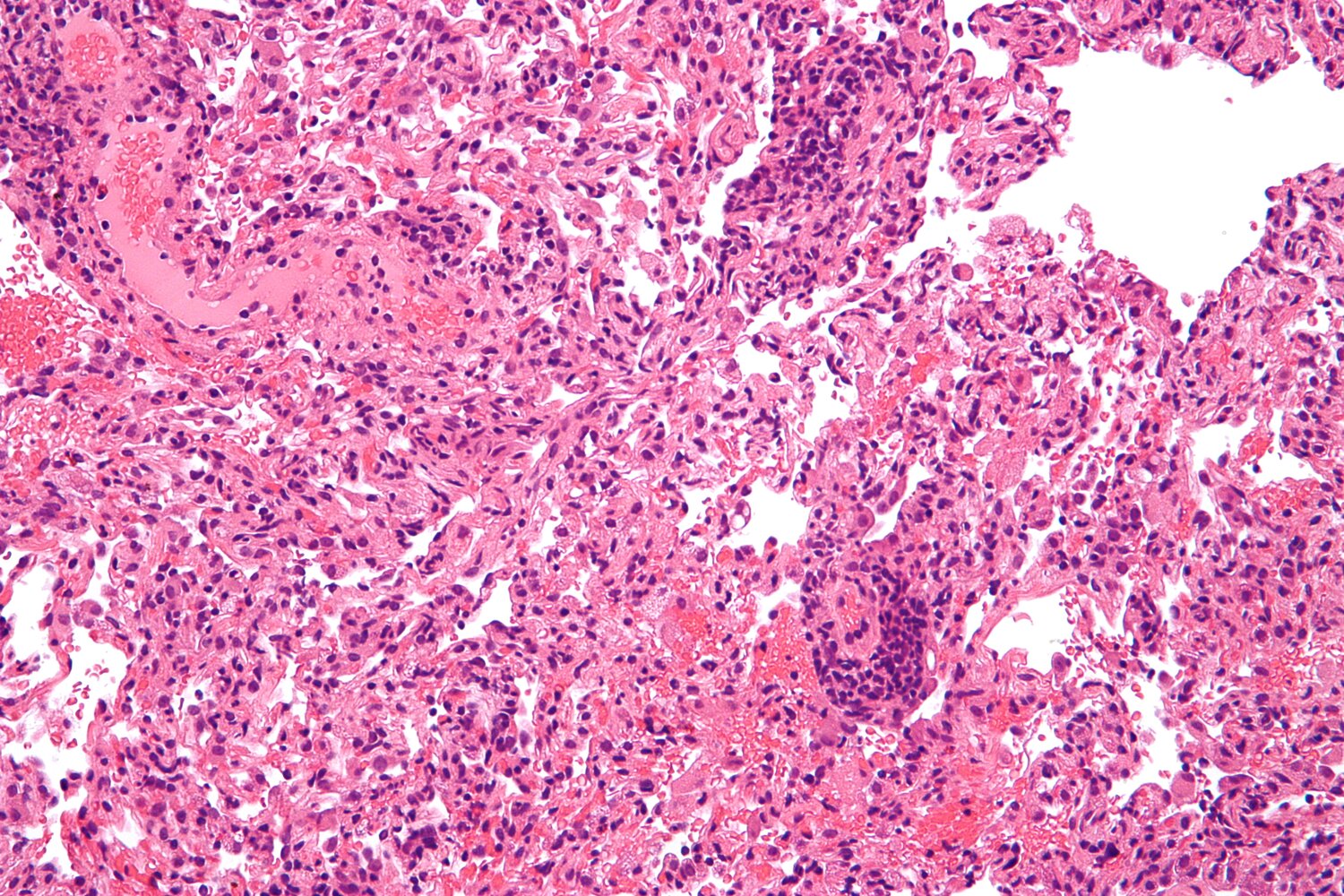 Acute transplant rejection