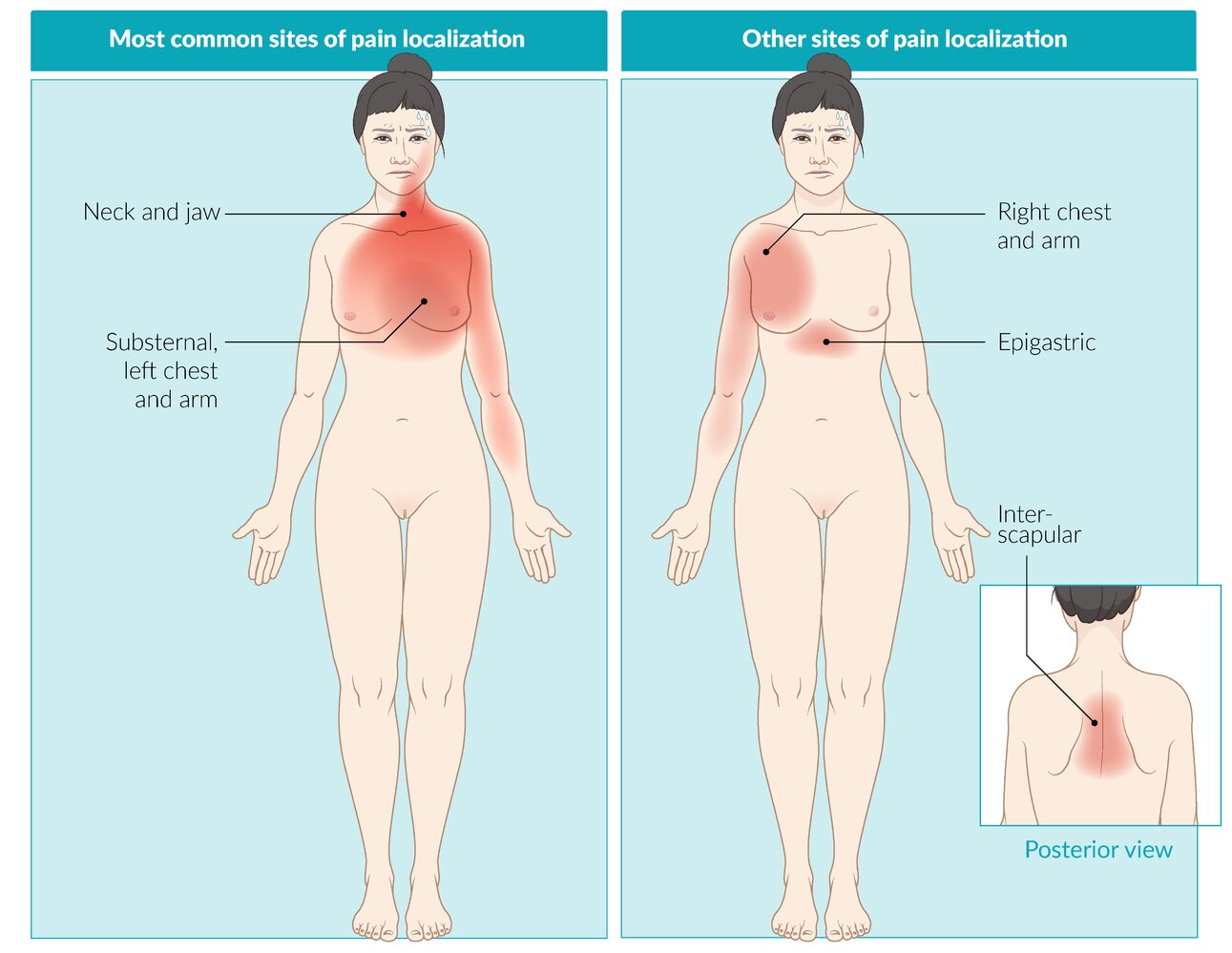 Chest pain localization in ACS