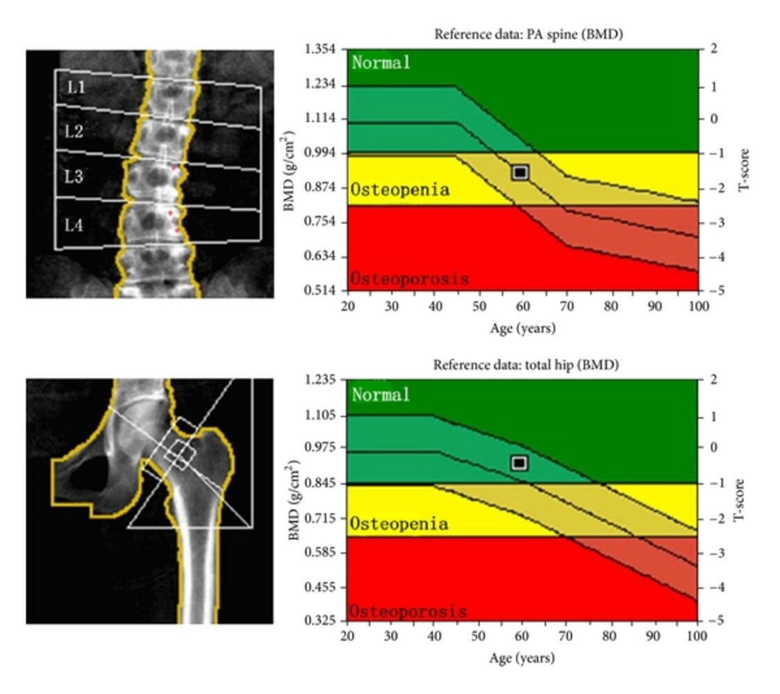 DXA scan in osteopenia