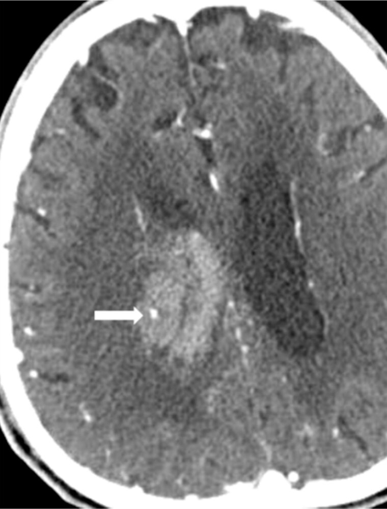 Spot sign in active intracerebral hemorrhage