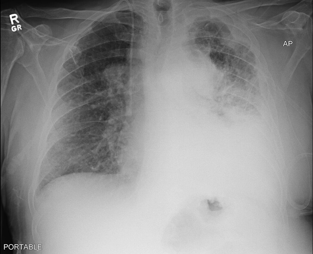 Pulmonary abnormalities in lung cancer
