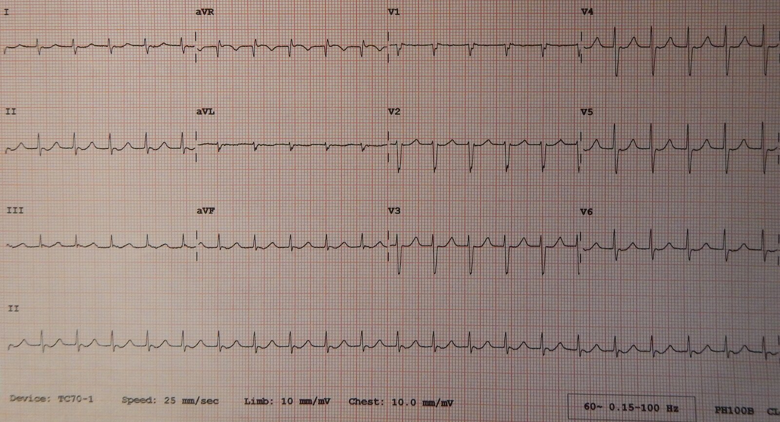 Junctional tachycardia