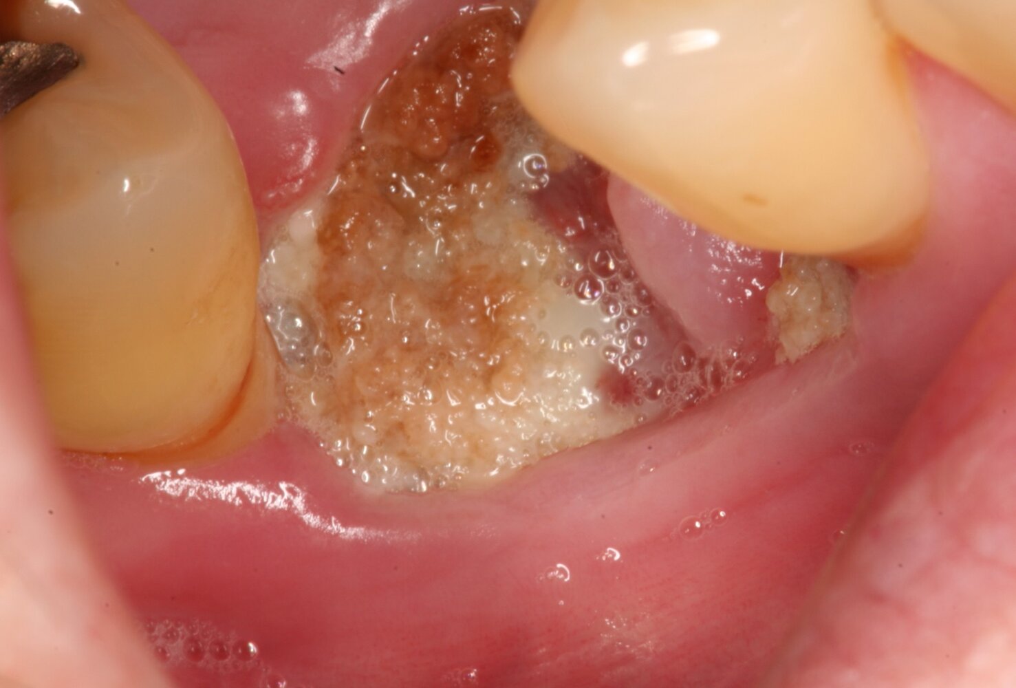Medication-related osteonecrosis of the jaw