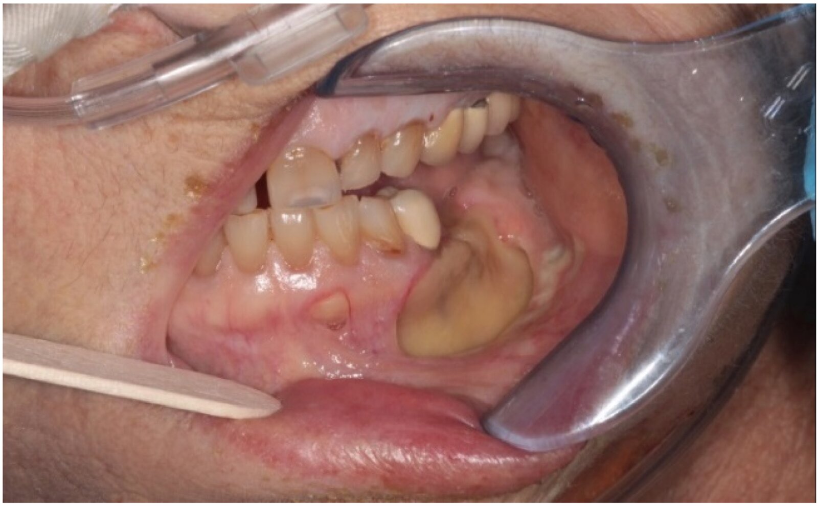Advanced medication-related osteonecrosis of the jaw