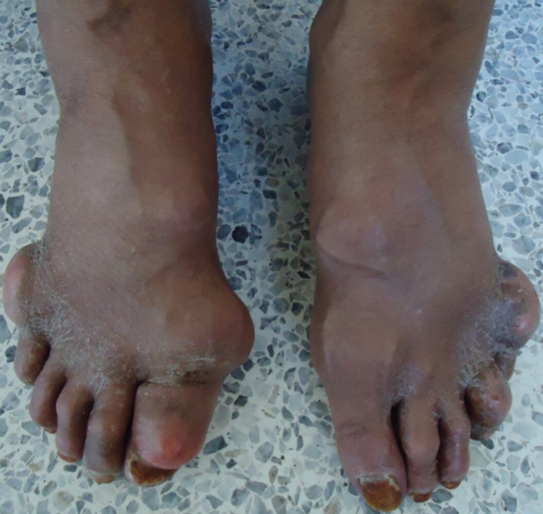 Gouty tophi in chronic gouty arthritis